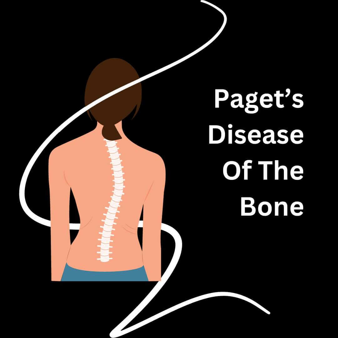 Paget S Disease Of Bone Symptoms Causes And Treatments Center For