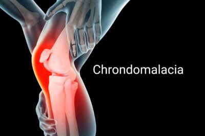 Chondromalacia: Causes, Symptoms & Treatment