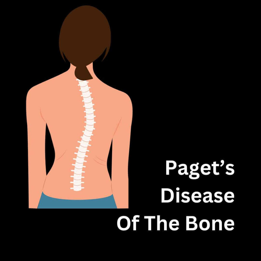 Paget's disease of the bone
