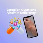 Ganglion Cyst Vitamin Deficiency