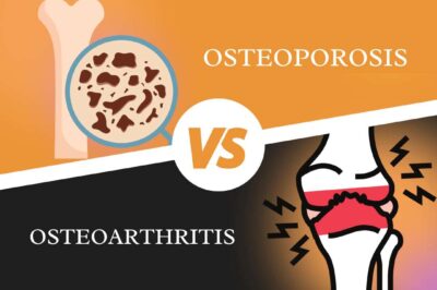 Osteoporosis And Arthritis: The Differences